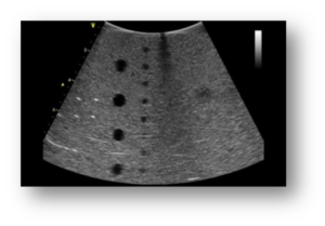 Dropout in an ultrasound image