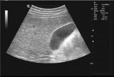 Ultrasound image with harmonics off