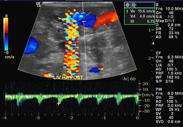 RF interference causing artifact in Color Doppler Imaging Mode.
