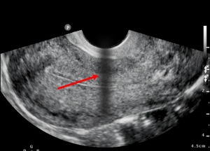 Image Dropout in an endo-cavity probe ultrasound image